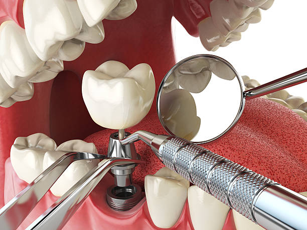 Best Emergency Dentist for Knocked-Out Tooth in Red Bay, AL